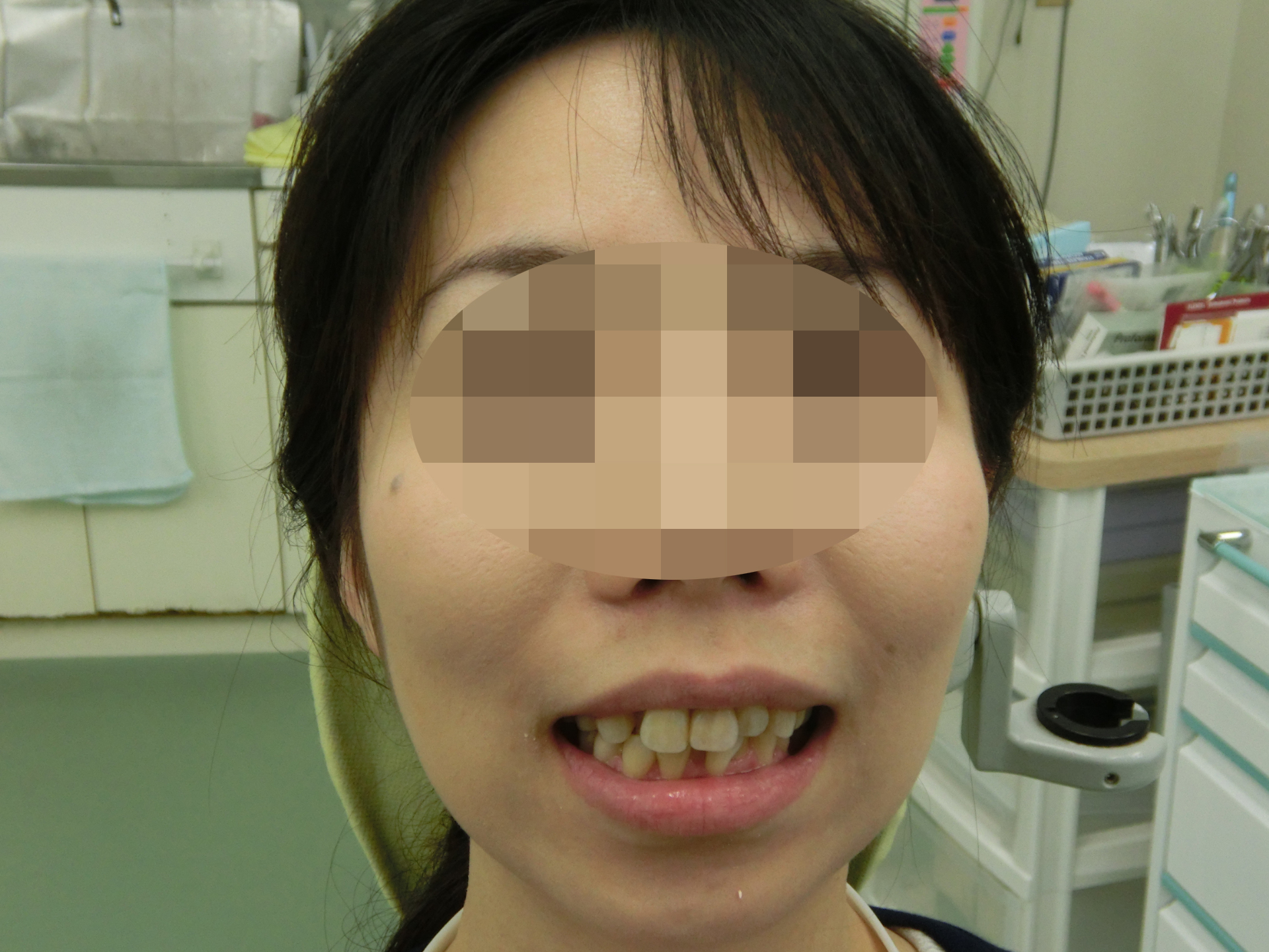 術前正面観-1