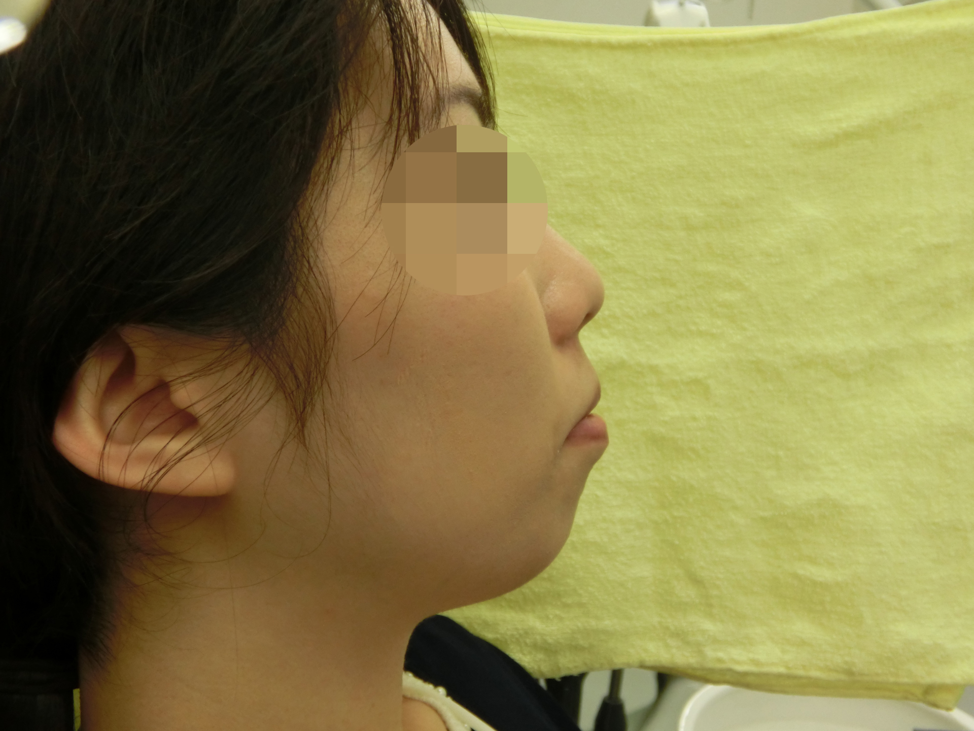 術前側方面観