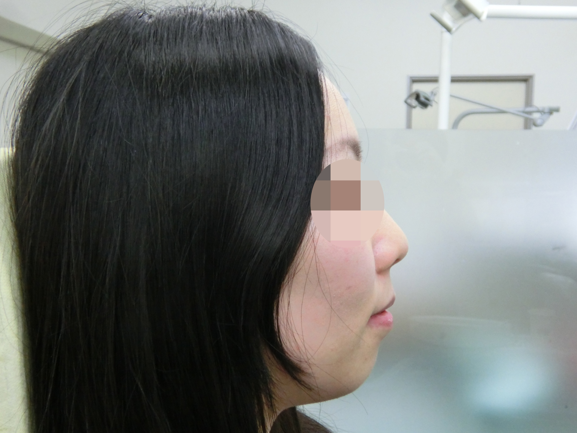 術後側方面観